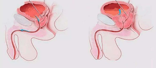 Signes de prostatite chez les hommes