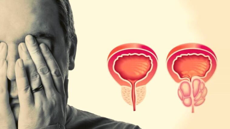 Un homme a une prostatite