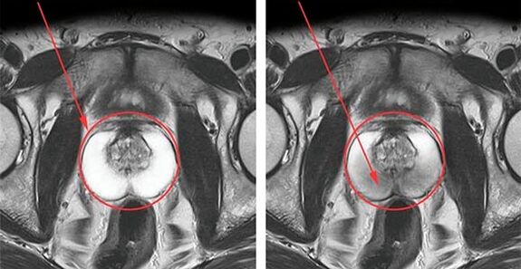 Prostate normale (à gauche) et inflammation de la prostate avec prostatite (à droite)
